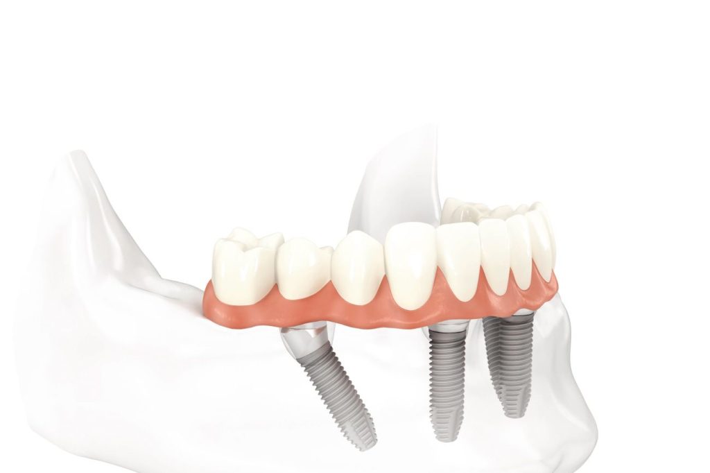 Impianto dentale senza o con poco osso