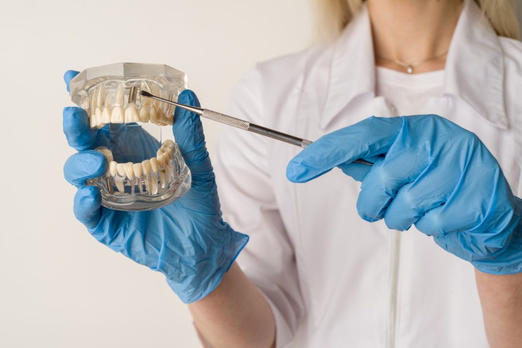 Tipologie di impianti dentali